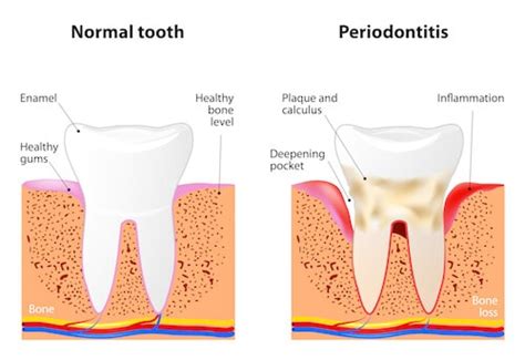 Dental Jargon Explained • National Dental.